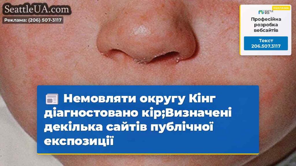 Немовляти округу Кінг діагностовано кір;Визначені