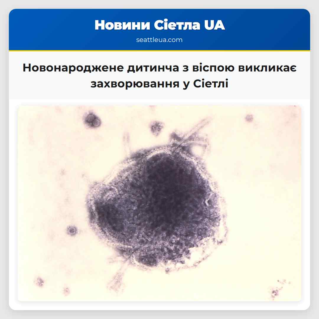 Новонароджене дитинча з віспою викликає